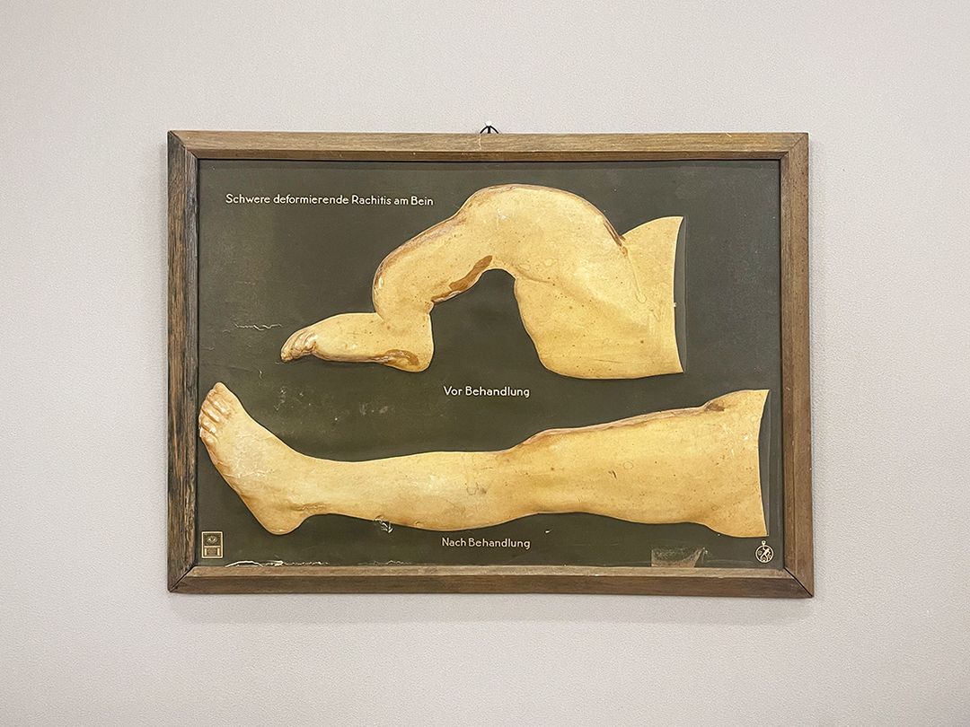 Foto Medical Study of Rachitis Legs h37x50 22A5